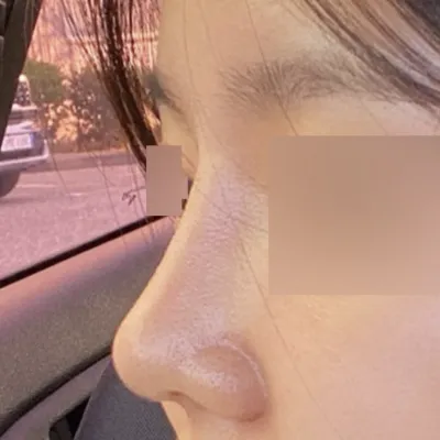 낮은 복코 성형한지 3개월됐어요