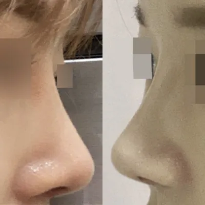 코 수술 받은지 벌써 3개월 지났어요