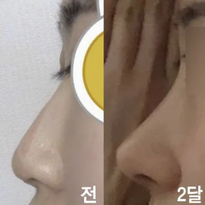 남자같은 매부리 화살코 세련되게 수술했어요!