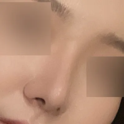 코수술하고 얼굴에 입체감이 생겼어용