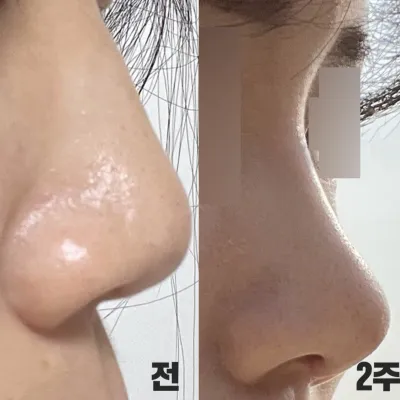 코 수술 받은지 한달 됐어요!