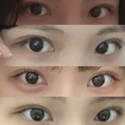 (자연유착 눈매교정 앞트임) 수술받은 지 4개월
