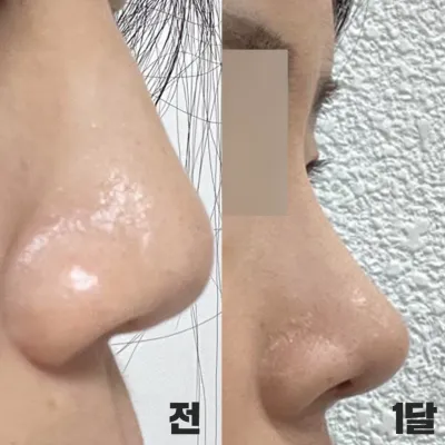 직반 느낌으로 코수술 받고 한달