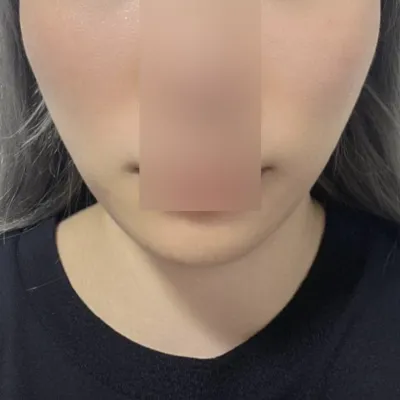 신경쓰이던 팔자주름 해결했어용~