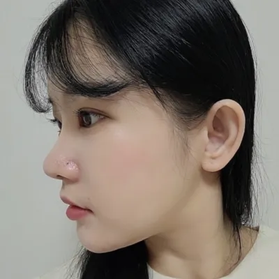 눈,코 재수술 한지 1달 지났어요