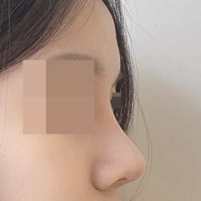 코수술 3달차 후기입니다!