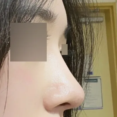 심정환 원장님께 수술 받고 4개월 됐습니다!