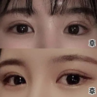 눈 가로로 길어졌어요! 재수술 성공 후