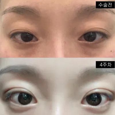 처진 눈꺼풀과 겹주름 고민 끝냈어요
