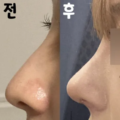 무보형물로 코수술한지 1개월 됐어여!