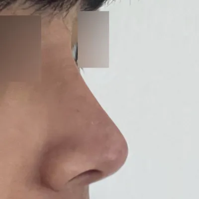 복코 수술 받은지 이제 3개월 됐습니다.