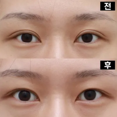 소세지눈 재수술 눈매교정까지 받고왔어요!