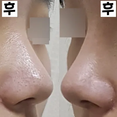 첫 코수술 2주 됐어요!