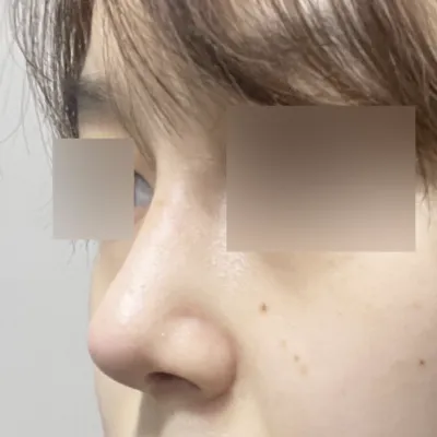 위버스성형외과에서 코재수술 받고 한달차 후기에요~!