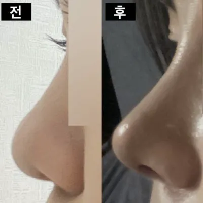 코수술한지 1달이나 됐네요 ㅎ