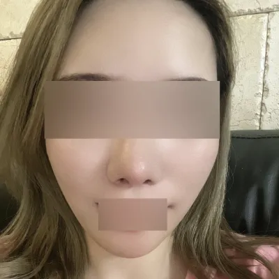 실리프팅 두 달 됐어요~