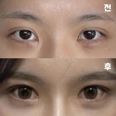 붓기 빠진 모습이 벌써부터 기대돼요