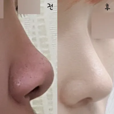 수술하고 자신감이 생겼어요!!