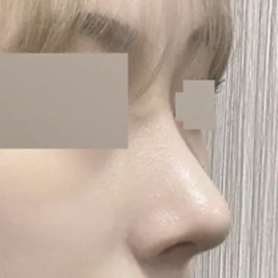 벌써 수술한지 2달차에여!!