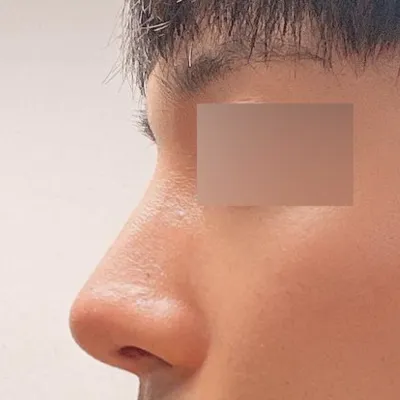 위버스성형외과에서 수술받은지 여섯달차입니다