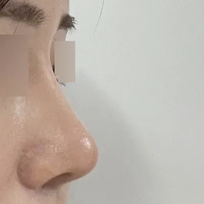 코 수술 받은지 이제 3달 됐어요!