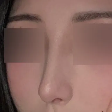 매부리코로 스트레스 받다가 마음 먹고 수술했습니다!!