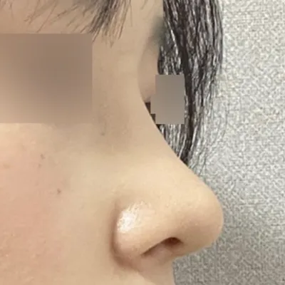 수술이 정말 잘 된 것 같아서 너무 만족중이에요!