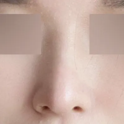 코 수술 받은지 6개월이나 흘렀네요