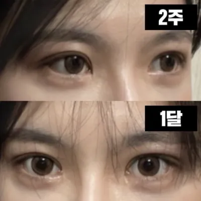 실밥빼고 시간 휙 하고 지나간 것 같아요!