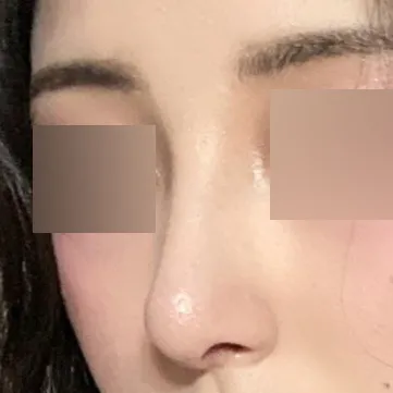 수술 한달차입니다.