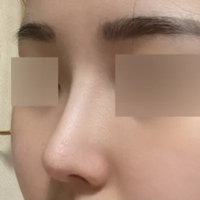 예쁘게 비염까지 수술 한지 6개월 됐어요