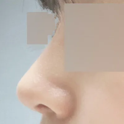 벌써 위버스성형외과에서 코수술한지 벌써 두달차네요