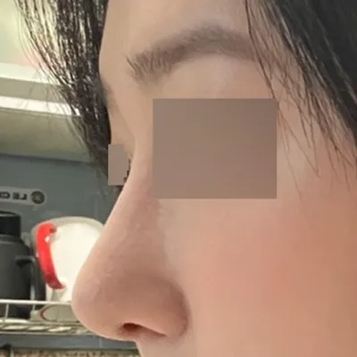 첫코수술에 여기저기 고민하다 드디어 코 수술 하였습니다.