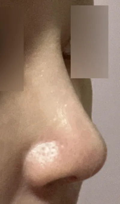 벌써 수술한지 6달지났어요