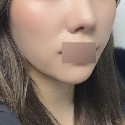 피치 실리프팅 3달차 됐어요