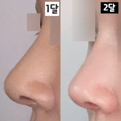 위버스성형외과 코재수술 2달차 후기