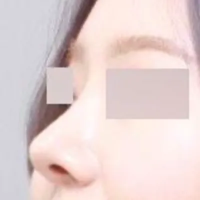 꺾인 매부리코 수술한지 벌써 6달 되어가요 ㅎㅎ