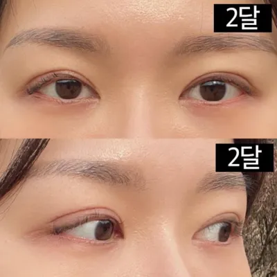 쌍수재수술과 눈매교정 받았습니다.