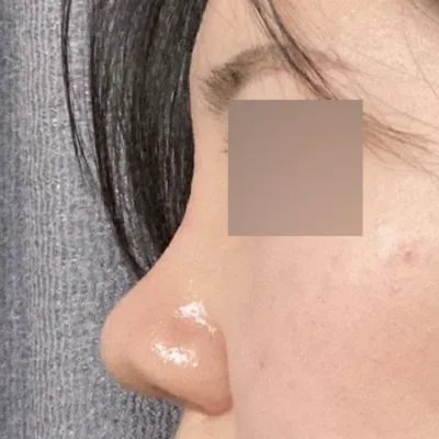 수술 1개월차 후기입니다 위버스성형외과 심정환 원장님한테 코수술 받았어요!