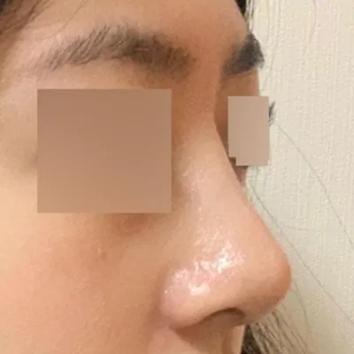 서승조 선생님께 수술 받은 한달차 후기입니다.