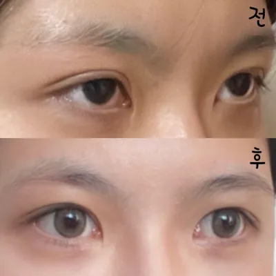 강남역 위버스성형외과에서 눈재수술한지 두달차 입니다!