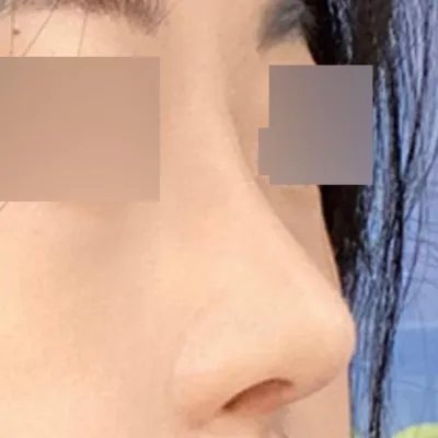 수술한지 2개월 됐는데 너무 만족스러워요.