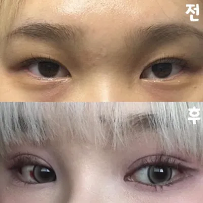 수술 대만족이요 다들 위버스 하세요!!