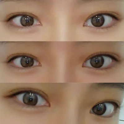 심정환 원장님께 비절개 눈매교정 받았어요!