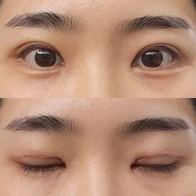 눈재수술 받은지 일주일 됐어요