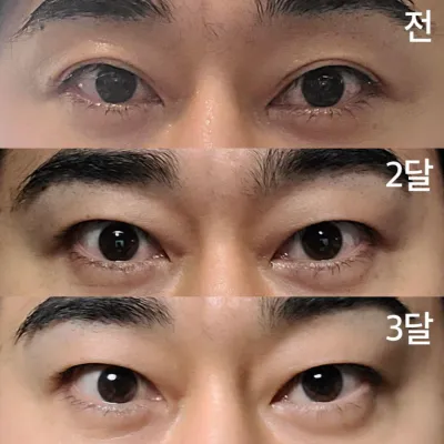 겹쌍꺼풀 눈 절개 3개월차 입니다.