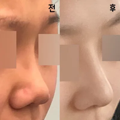 저도 드디어 워너비 코 얻은거 같아여!!