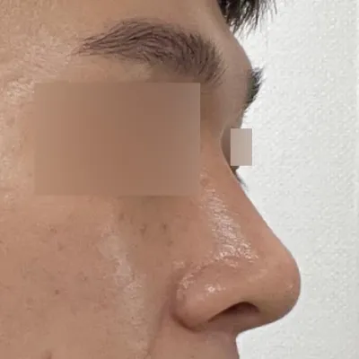 서승조 원장님께 코 수술을 받은 지 2달 차입니다.