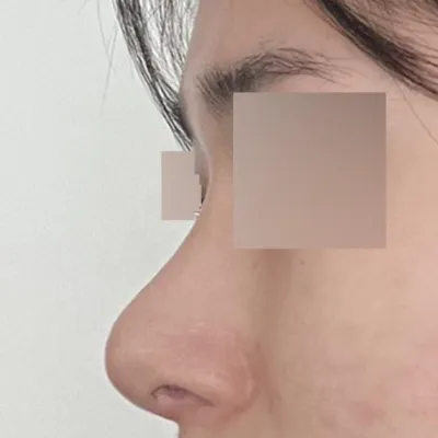 위버스 성형외과 의원에서 코 수술한지 두달 차 입니다.