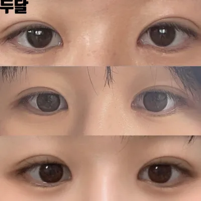 심정환원장님한테 눈코 수술받은지 두달차 후기 남겨요